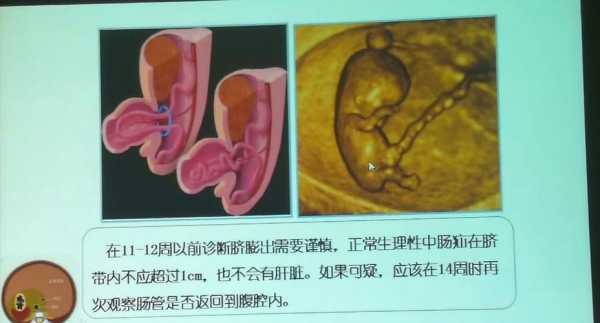 胎儿脐(胎儿脐膨出是什么原因导致的呢) 第3张 胎儿脐(胎儿脐膨出是什么原因导致的呢) 第3张