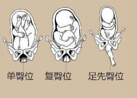 胎儿 臀位(胎儿臀位是什么姿势图) 第1张 胎儿 臀位(胎儿臀位是什么姿势图) 第1张
