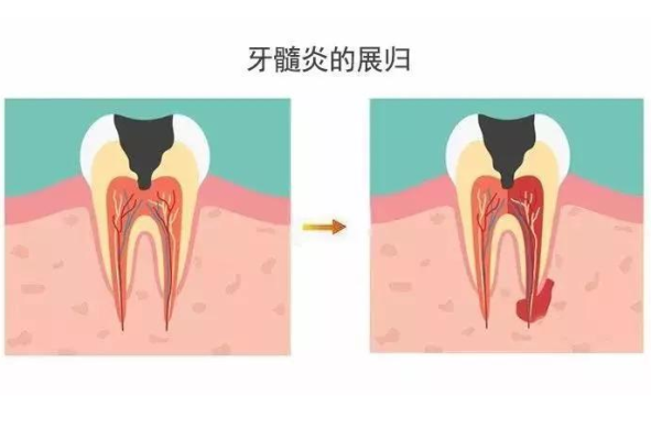 孕期牙周炎（孕期牙痛如何治疗）  第1张
