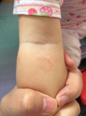 为什么宝宝胳膊腿上总是一块块的跟橘子皮一样的皮,胎儿腿偏短怎么补救 第1张 为什么宝宝胳膊腿上总是一块块的跟橘子皮一样的皮,胎儿腿偏短怎么补救 第1张