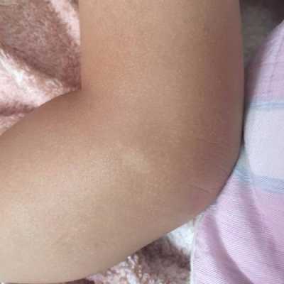 为什么宝宝胳膊腿上总是一块块的跟橘子皮一样的皮,胎儿腿偏短怎么补救 第2张 为什么宝宝胳膊腿上总是一块块的跟橘子皮一样的皮,胎儿腿偏短怎么补救 第2张