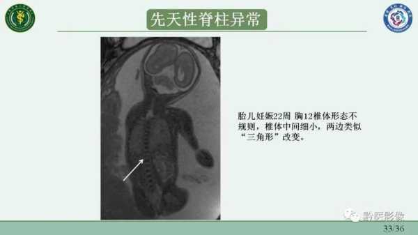 胎儿脊椎排列欠自然是为什么,胎儿脊柱骶尾部相互靠拢且略向后翘 第2张 胎儿脊椎排列欠自然是为什么,胎儿脊柱骶尾部相互靠拢且略向后翘 第2张