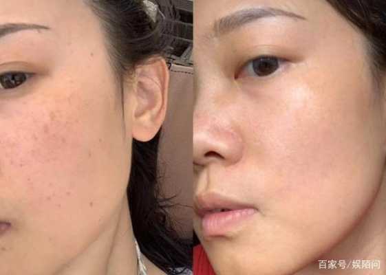 孕期长斑怎么办（孕期长斑怎么办以后会退吗）  第1张