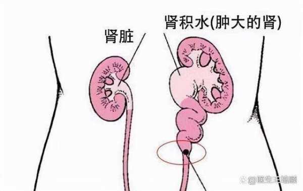 孕妇肾积水怎么办,胎儿肾积水是什么原因引起的 第2张 孕妇肾积水怎么办,胎儿肾积水是什么原因引起的 第2张