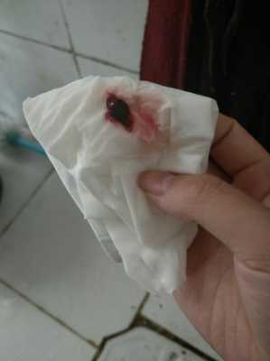 边缘性前置胎盘老是反复流血，怎么办,孕期反复出血但查了都没事的宝妈  第1张