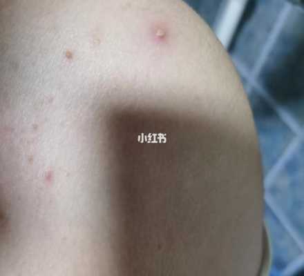 怀孕长痘痘怎么回事,怀孕期间长痘痘是什么原因 第2张 怀孕长痘痘怎么回事,怀孕期间长痘痘是什么原因 第2张