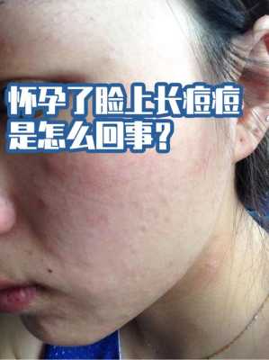 怀孕长痘痘怎么回事,怀孕期间长痘痘是什么原因 第3张 怀孕长痘痘怎么回事,怀孕期间长痘痘是什么原因 第3张