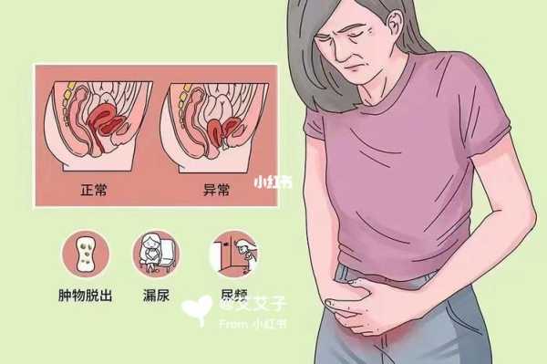 子宫脱垂是怎么回事,孕期子宫脱垂的症状是什么 第1张 子宫脱垂是怎么回事,孕期子宫脱垂的症状是什么 第1张