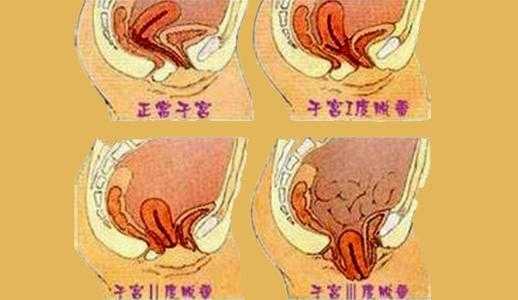 子宫脱垂是怎么回事,孕期子宫脱垂的症状是什么 第2张 子宫脱垂是怎么回事,孕期子宫脱垂的症状是什么 第2张