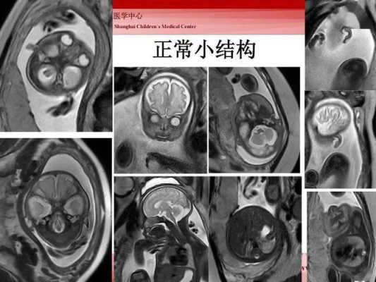 胎儿磁共振(新生儿照核磁共振是为什么) 第2张 胎儿磁共振(新生儿照核磁共振是为什么) 第2张