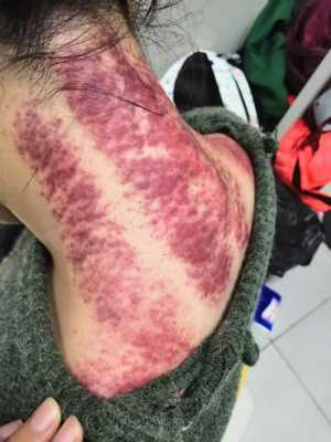 孕妇感冒可以刮痧吗,孕期可以刮痧吗只刮脖子 第1张 孕妇感冒可以刮痧吗,孕期可以刮痧吗只刮脖子 第1张