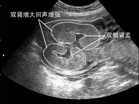 胎儿系统(胎儿左肾集合系统分离是怎么回事) 第1张 胎儿系统(胎儿左肾集合系统分离是怎么回事) 第1张