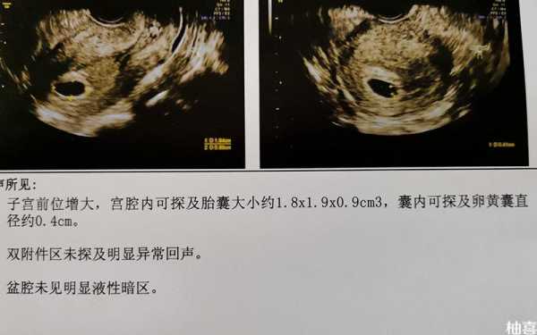 孕7周胚芽大小多少是正常的?怎么判断宝宝是否是健康的呢,7周胎儿发育情况图片 第1张 孕7周胚芽大小多少是正常的?怎么判断宝宝是否是健康的呢,7周胎儿发育情况图片 第1张