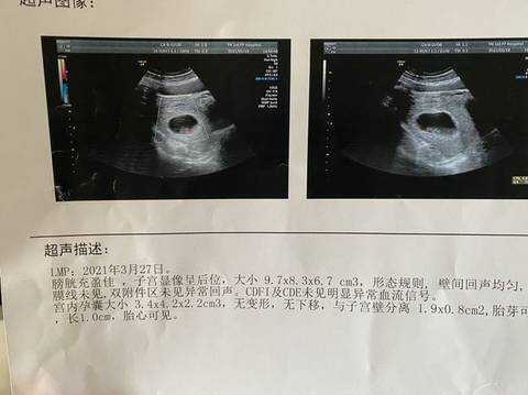 孕7周胚芽大小多少是正常的?怎么判断宝宝是否是健康的呢,7周胎儿发育情况图片 第2张 孕7周胚芽大小多少是正常的?怎么判断宝宝是否是健康的呢,7周胎儿发育情况图片 第2张