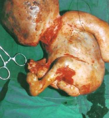 胎儿死亡（胎儿死亡孕妇有啥症状）  第3张
