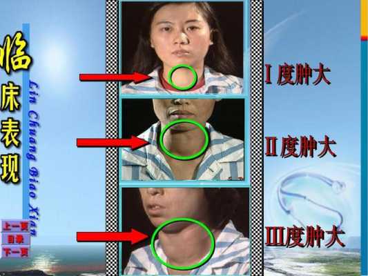 甲亢会遗传给宝宝吗,胎儿遗传谁的基因更多 第1张 甲亢会遗传给宝宝吗,胎儿遗传谁的基因更多 第1张