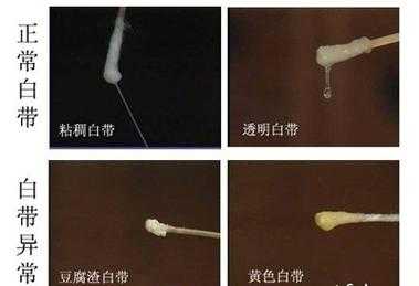 孕期阴道分泌物(孕期白色分泌物多正常吗) 第2张 孕期阴道分泌物(孕期白色分泌物多正常吗) 第2张