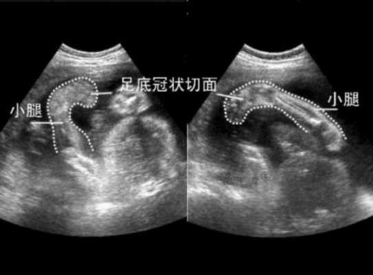 胎儿左足有点不正是什么原因,胎儿不正怎么回事 第2张 胎儿左足有点不正是什么原因,胎儿不正怎么回事 第2张
