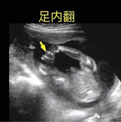 胎儿左足有点不正是什么原因,胎儿不正怎么回事 第1张 胎儿左足有点不正是什么原因,胎儿不正怎么回事 第1张