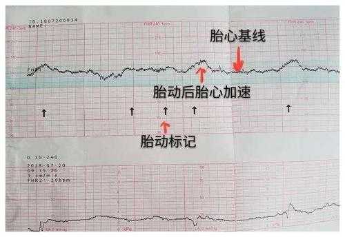 胎心监测什么时候做,胎儿监测是什么意思 第2张 胎心监测什么时候做,胎儿监测是什么意思 第2张