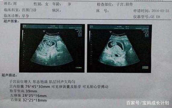 刚出生的婴儿怎么辨别男孩女孩,胎儿男女怎么看b超单 第1张 刚出生的婴儿怎么辨别男孩女孩,胎儿男女怎么看b超单 第1张