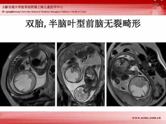 胎儿核(胎儿核磁共振对宝宝有影响吗) 第3张 胎儿核(胎儿核磁共振对宝宝有影响吗) 第3张