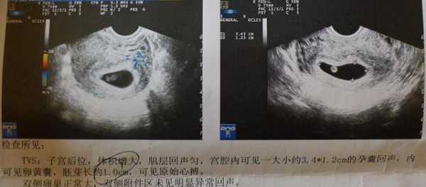 怀孕八周孕囊多大正常,八周胎儿有多大图片 第3张 怀孕八周孕囊多大正常,八周胎儿有多大图片 第3张