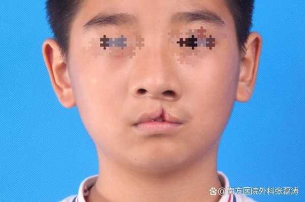 胎儿唇裂(胎儿唇裂是什么原因造成的) 第2张 胎儿唇裂(胎儿唇裂是什么原因造成的) 第2张
