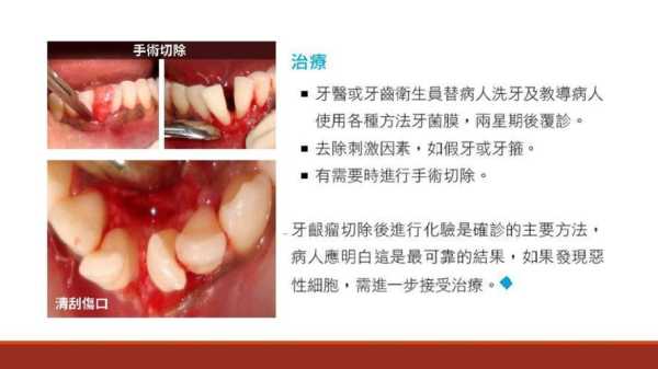 孕期牙龈瘤(牙龈瘤的治疗方法是什么) 第1张 孕期牙龈瘤(牙龈瘤的治疗方法是什么) 第1张