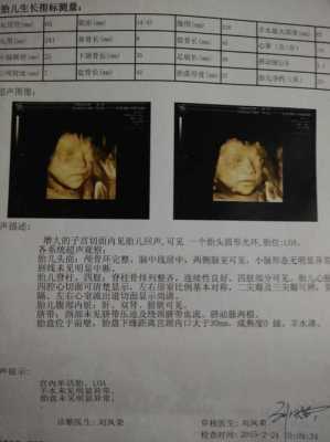 胎儿大排畸(大排畸多少周可以做) 第2张 胎儿大排畸(大排畸多少周可以做) 第2张