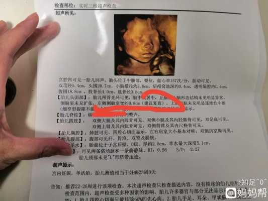 胎儿左侧侧脑室(胎儿一侧侧脑室见宽约0,6cm液性暗区意味着什么) 第2张 胎儿左侧侧脑室(胎儿一侧侧脑室见宽约0,6cm液性暗区意味着什么) 第2张