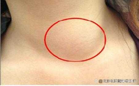 孕期甲减症状(甲状腺疾病的主要症状是什么) 第2张 孕期甲减症状(甲状腺疾病的主要症状是什么) 第2张