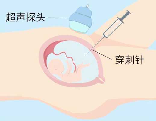 胎儿羊水穿刺(孕妇做羊水穿刺有多大风险) 第1张 胎儿羊水穿刺(孕妇做羊水穿刺有多大风险) 第1张