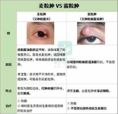 孕期麦粒肿(孕妇长麦粒肿怎么办) 第1张 孕期麦粒肿(孕妇长麦粒肿怎么办) 第1张