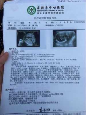 地贫胎儿(地贫胎儿超声表现) 第1张 地贫胎儿(地贫胎儿超声表现) 第1张