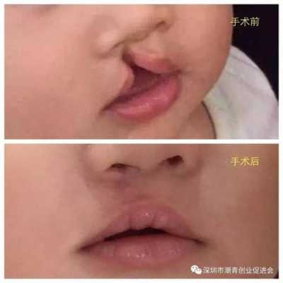 我女友是兔唇,家人怕遗传,强烈反对,我该怎么办,胎儿唇腭裂是怎么造成的 第1张 我女友是兔唇,家人怕遗传,强烈反对,我该怎么办,胎儿唇腭裂是怎么造成的 第1张