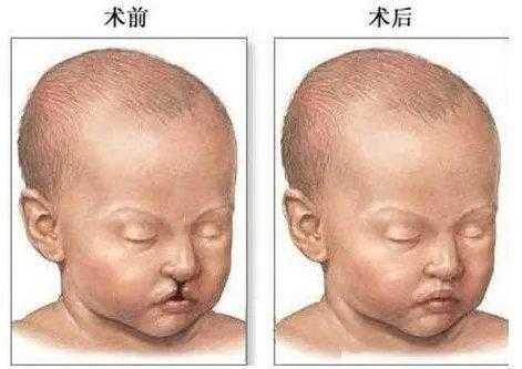 我女友是兔唇,家人怕遗传,强烈反对,我该怎么办,胎儿唇腭裂是怎么造成的 第2张 我女友是兔唇,家人怕遗传,强烈反对,我该怎么办,胎儿唇腭裂是怎么造成的 第2张