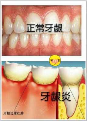 孕妇牙龈发炎怎么办,孕期牙龈炎怎么治疗 第3张 孕妇牙龈发炎怎么办,孕期牙龈炎怎么治疗 第3张