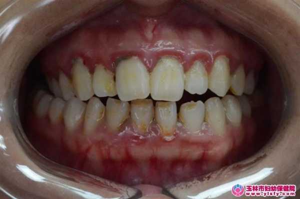 孕妇牙龈发炎怎么办,孕期牙龈炎怎么治疗 第2张 孕妇牙龈发炎怎么办,孕期牙龈炎怎么治疗 第2张