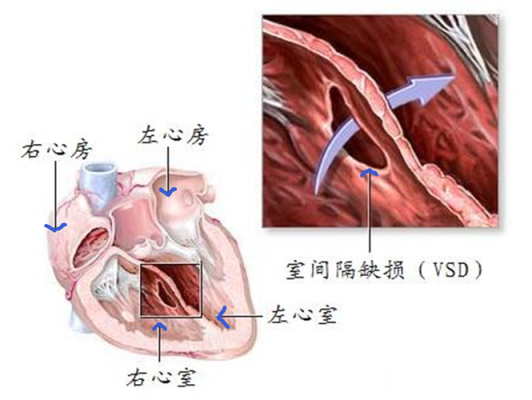 室缺是由什么原因引起的,胎儿室缺一般什么原因引起的 第1张 室缺是由什么原因引起的,胎儿室缺一般什么原因引起的 第1张