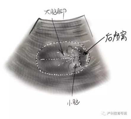 胎儿后颅窝池大,有影响吗?怎么解决,胎儿后颅窝池增宽是什么原因 第1张 胎儿后颅窝池大,有影响吗?怎么解决,胎儿后颅窝池增宽是什么原因 第1张