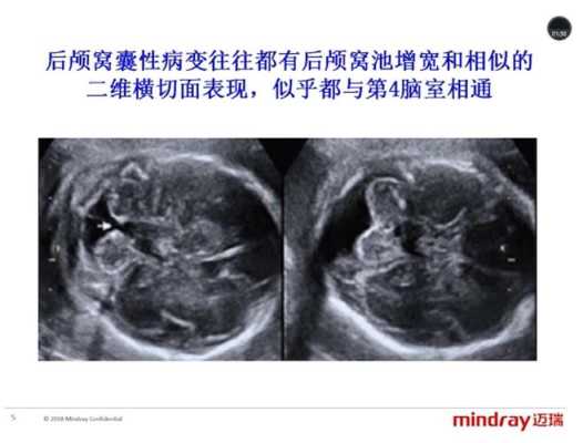 胎儿后颅窝池大,有影响吗?怎么解决,胎儿后颅窝池增宽是什么原因 第2张 胎儿后颅窝池大,有影响吗?怎么解决,胎儿后颅窝池增宽是什么原因 第2张