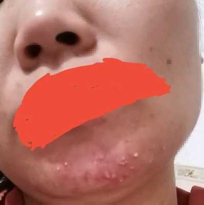 孕期下巴长痘痘(孕期下巴长痘痘) 第2张 孕期下巴长痘痘(孕期下巴长痘痘) 第2张