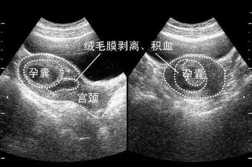 绒毛膜下出血是怎么回事,胎儿绒毛检查能检查出什么 第1张 绒毛膜下出血是怎么回事,胎儿绒毛检查能检查出什么 第1张