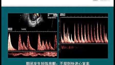 胎儿心律不齐(胎儿心律不齐) 第2张 胎儿心律不齐(胎儿心律不齐) 第2张
