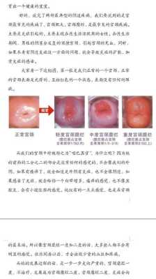 孕期宫颈糜烂出血（检查出宫颈糜烂三度，有接触性出血，请问怎么治疗）  第2张