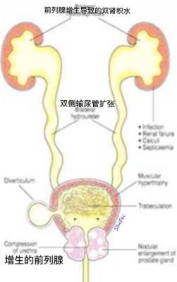 孕期肾积水怎么办(畸形筛查胎儿肾积水怎么办) 第3张 孕期肾积水怎么办(畸形筛查胎儿肾积水怎么办) 第3张