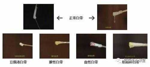 孕期白带颜色(孕期分泌物颜色对照表) 第2张 孕期白带颜色(孕期分泌物颜色对照表) 第2张