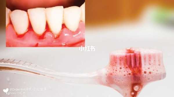 孕期牙龈出血怎么办(孕期刷牙牙龈出血怎么回事) 第2张 孕期牙龈出血怎么办(孕期刷牙牙龈出血怎么回事) 第2张