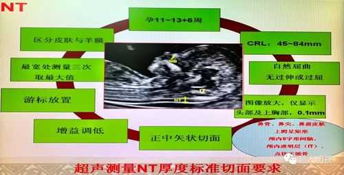 胎儿nt增厚(ntlf厚代表什么) 第2张 胎儿nt增厚(ntlf厚代表什么) 第2张